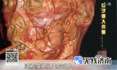 <b>室CT机的下为孩子铲除了筷子</b>
